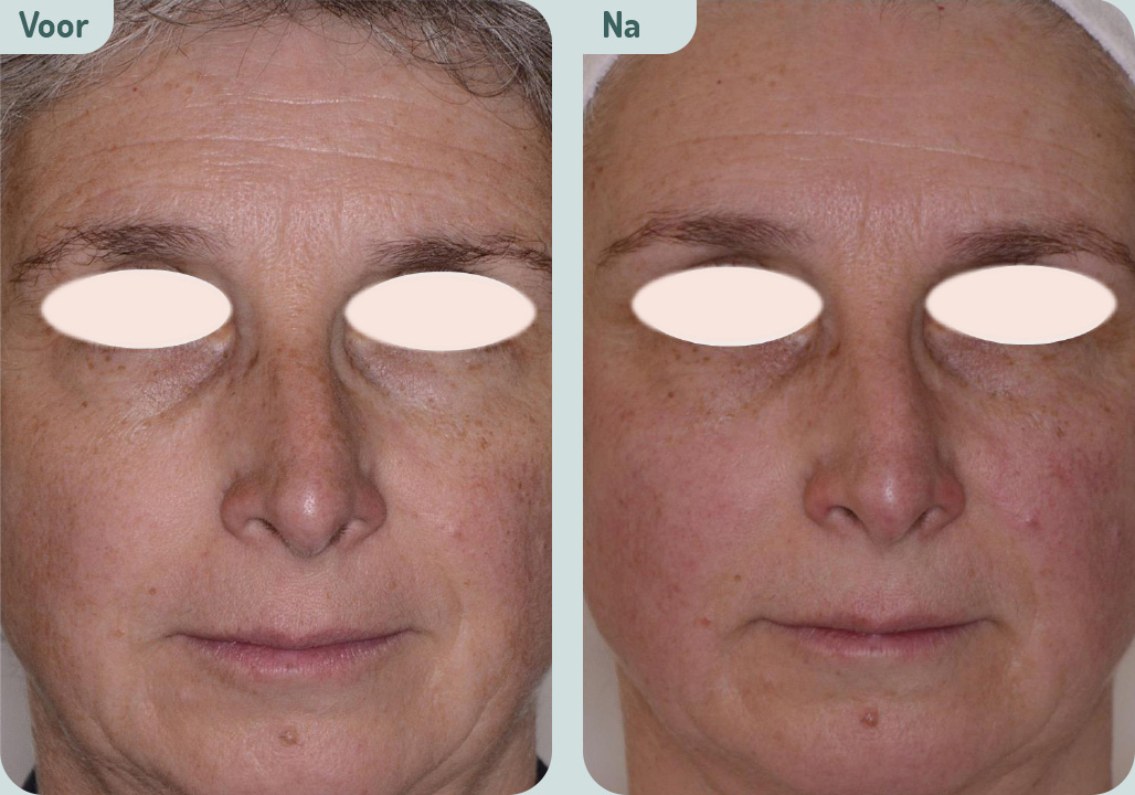 Microneedling voor en na