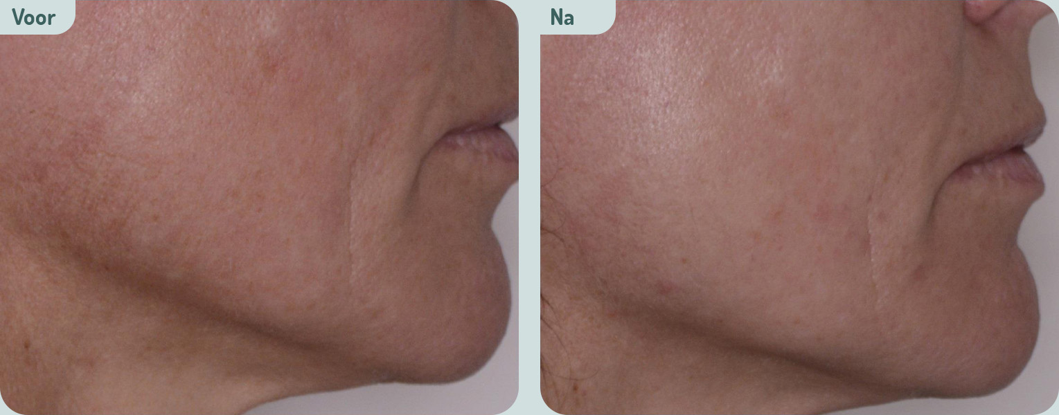 Microneedling resultaat na 6 behandelingen